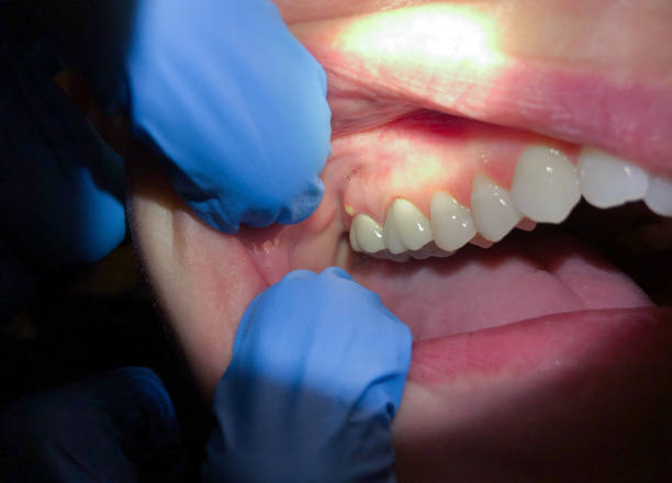 Best Emergency Treatment for Toothache in Colchester, IL